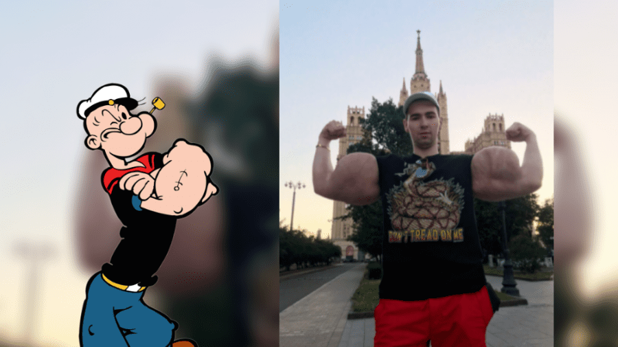 Tânărul cu bicepși gigantici a recunoscut că a făcut o prostie. A suferit prima intervenție chirurgicală!