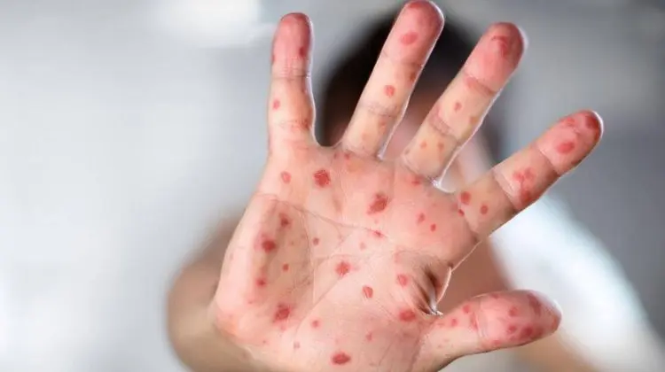 Ce știm despre variola maimuței: are sau nu epidemia vreo legătură cu aceste animale?