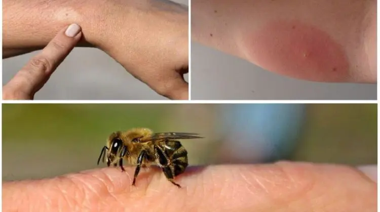În Moldova, crește numărul de reacții grave la înțepături de insecte! Medicii au înregistrat Cod Roșu de alertă
