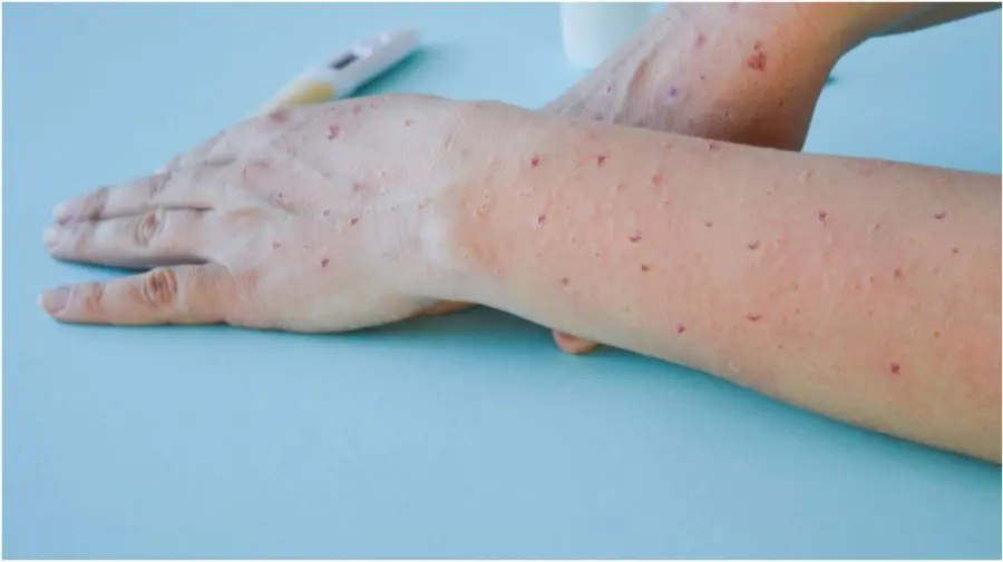 Un caz de variola maimuței, confirmat în Moldova. ANSP a inițiat ancheta epidemiologică