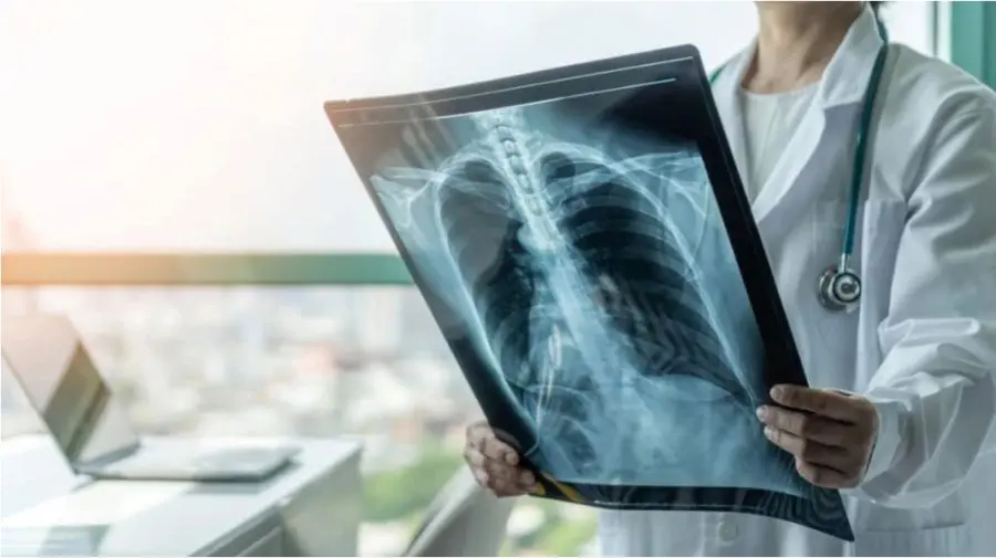 Ce arată cifrele despre tuberculoză în Moldova. Cazurile scad, dar pericolul persistă