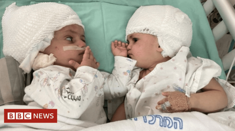 VIDEO Operație de separare unică în Israel! Doua fetițe gemene s-au văzut la un an de la naștere