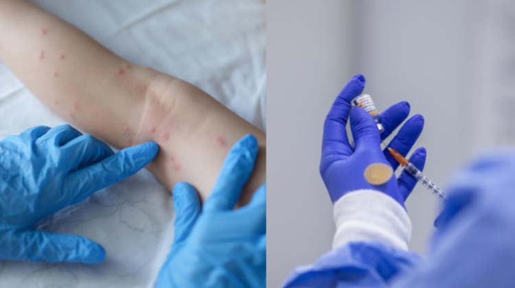 Variola maimuței face ravagii în Europa. UE va cumpăra peste 100 de mii de doze de vaccin împotriva variolei maimuței