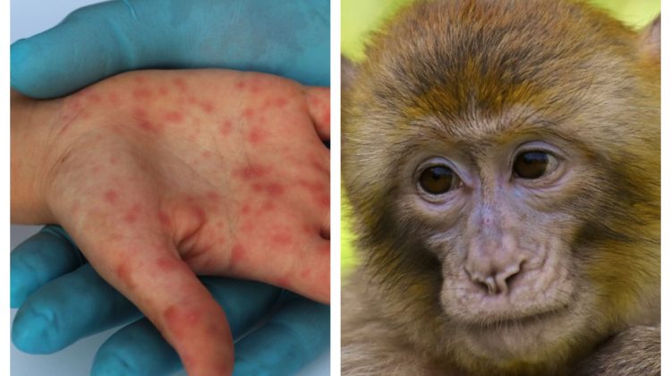 Primul copil infectat cu variola maimuței. Medicii sunt uluiţi