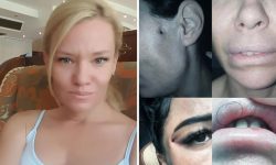 „Mi-a distrus fața”. O dentistă din Moldova făcea operații estetice fără drept de practică