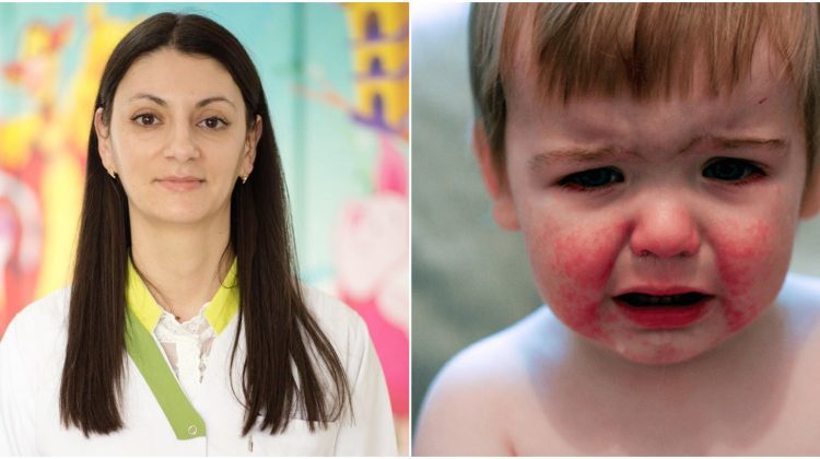 Eritemul infecțios, a cincea boală a copilăriei. Irina Secu, dacă este sau nu contagioasă și care sunt simptomele