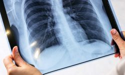 ANTI-RECORD Republica Moldova se situează în topul statelor cu cea mai înaltă incidență a tuberculozei