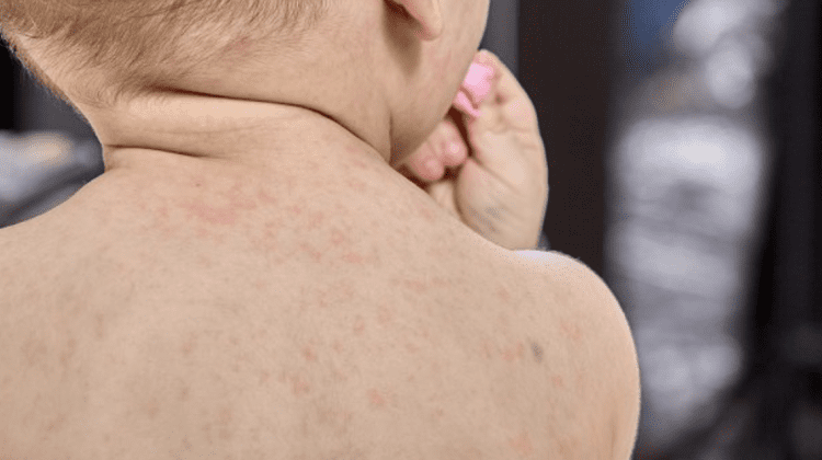 Bebeluș de cinci luni din Moldova, diagnosticat cu rujeolă. ANSP: Copilul este spitalizat