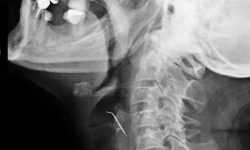 GROAZNIC! O femeie a stat 43 de zile cu un cui în gât fără să-și dea seama. A fost operată imediat
