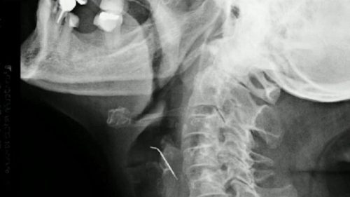 GROAZNIC! O femeie a stat 43 de zile cu un cui în gât fără să-și dea seama. A fost operată imediat