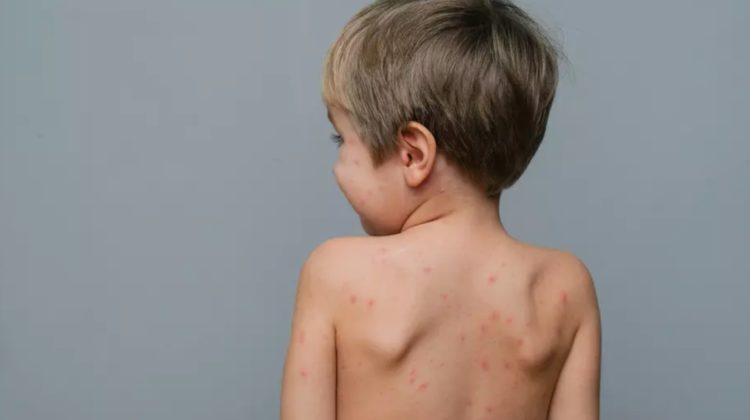 Părinții, îndemnați să-și vaccineze copiii împotriva rujeolei: O persoană diagnosticată poate să infecteze alte 18