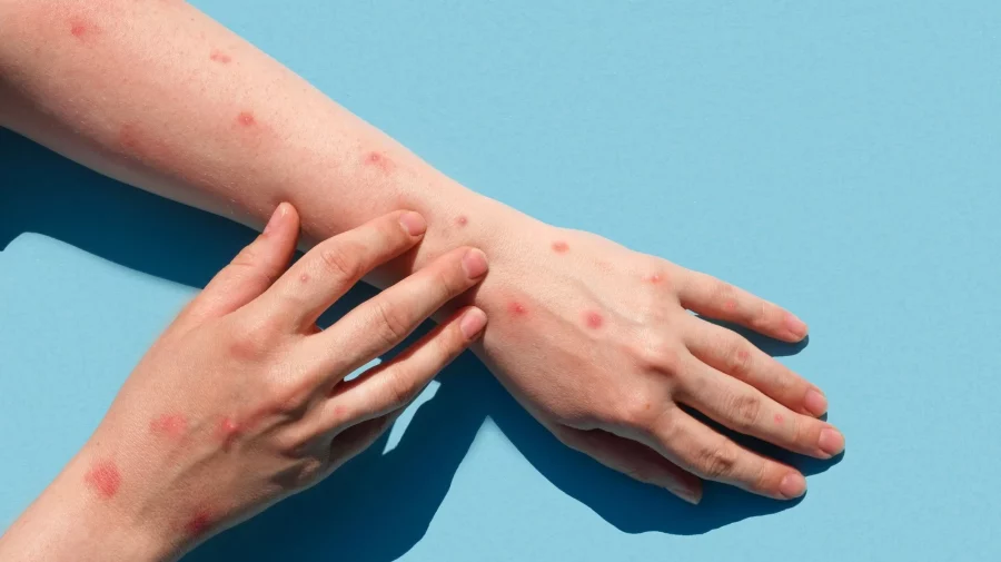 Alertă medicală: o variantă mai periculoasă a virusului mpox a fost depistată în Europa