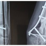 Infecția gravă a osului care nu trece de la sine: Simptome și tratament