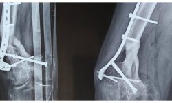 Infecția gravă a osului care nu trece de la sine: Simptome și tratament