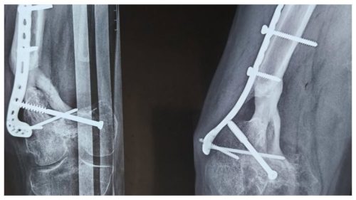 Infecția gravă a osului care nu trece de la sine: Simptome și tratament