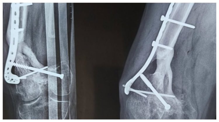 Infecția gravă a osului care nu trece de la sine: Simptome și tratament