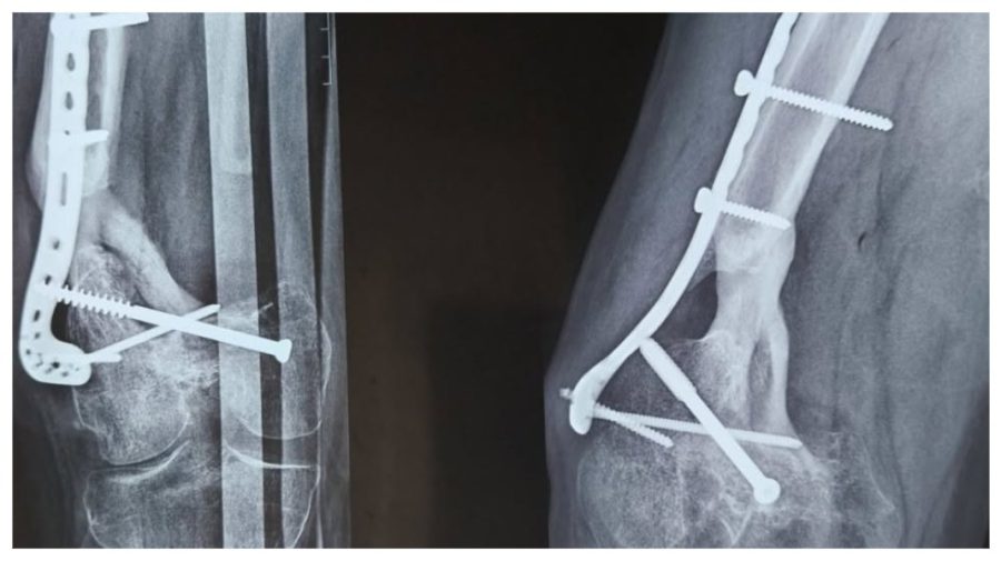Infecția gravă a osului care nu trece de la sine: Simptome și tratament